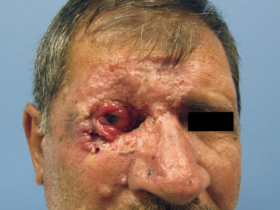 Базалиома кожи лица лечение лучевой терапией