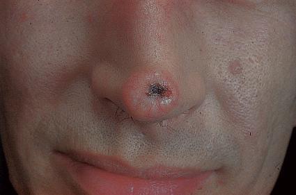 базалиома кожи носа в виде узла с изъязвлением в центре, покрытым струпом