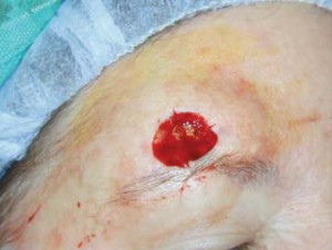 Рана кожи лба округлой формы, образовалась после вырезания тканей базалиомы