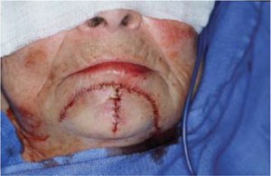 Рана, зашитая отдельными швами, напоминает букву Э, обращенную дугой в сторону нижней губы