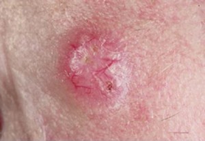На фото базально-клеточный рак в виде возвышающегося розового узла с теленгиэктазиями и блеском.
