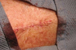 Рана зашита косметическими швами, не заметными с поверхности кожи