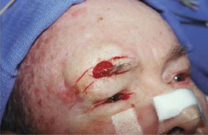 Овальная рана после удаления базалиомы в области брови