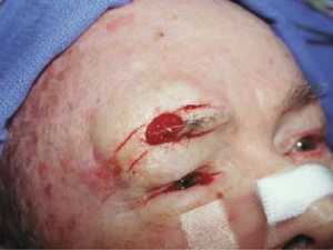 Овальная рана после удаления базалиомы в области брови