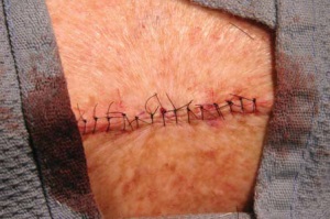 Рана затянута обычными отдельными узловыми швами