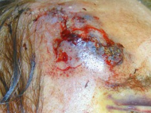 Кровоподтек в области раны от удаления базалиомы