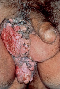 На фото рак кожи мошонки в виде бугристой, похожей на множество слившихся папиллом, ткани