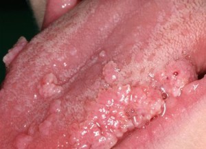 Бородавчатые розовые участки на слизистой языка - Болезнь Хека от вируса папилломы человека