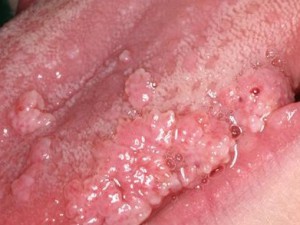 Бородавчатые розовые участки на слизистой языка - Болезнь Хека от вируса папилломы человека