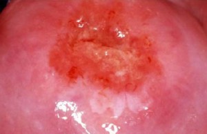 Рак шейки матки от вируса папилломы , слегка разрушающий, поверхность ярко красная.