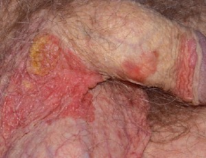 Болезнь Боуэна в виде многоочаговой бляшки неправильной формы, красного цвета, с участками роговых масс. Вирус папилломы у мужчин - основная причина.