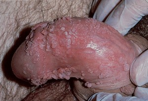 Телесного цвета плотные сосочковые разрастания (кондиломы) на коже полового члена вызвал вирус папилломы у мужчин