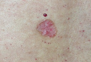 Базалиома (рак кожи). Бляшка с возвышенными перламутровыми краями. В центре розовая.