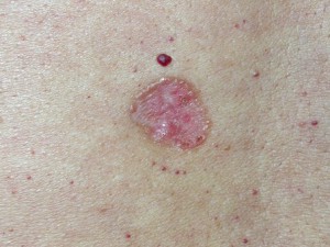 Базалиома (рак кожи). Бляшка с возвышенными перламутровыми краями. В центре розовая.