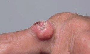 Плоскоклеточный рак кожи, похожий на кератоакантому, появился на пальце кисти.