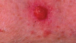 Плоскоклеточный рак кожи в виде красного кровоточащего узла, мягкого при пальпации.