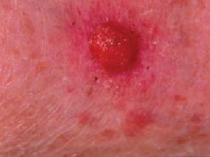 Плоскоклеточный рак кожи в виде красного кровоточащего узла, мягкого при пальпации.