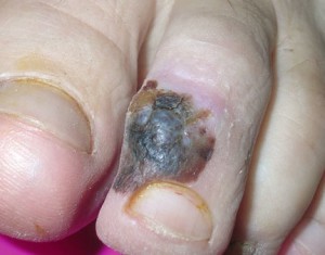 Черное пятно на пальце. Появилось само, расте не болит, не проходит. Это меланома.