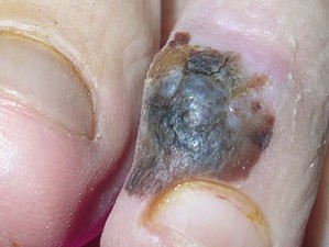 Черное пятно на пальце. Появилось само, растет не болит, не проходит. Это меланома.