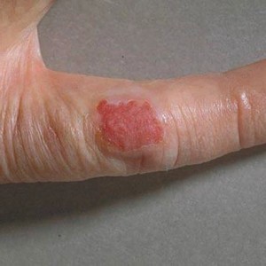 Розовая пятно на пальце руки с неправильными фестончатыми краями, чуть больше 2-х см в диаметре. Начальные признаки рака кожи.