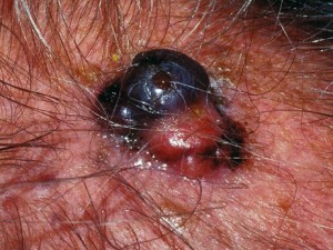 Бугристая опухоль выросла из родинки. Местами черная и розовая. Не болит. Это меланома.