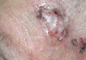 Рак кожи базалиома. Свтлое уплотнение в коже. Бугристое, не болит, иногда кровоточит.