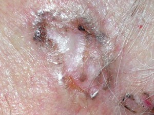 Рак кожи базалиома. Светлое уплотнение в коже. Бугристое, не болит, иногда кровоточит.