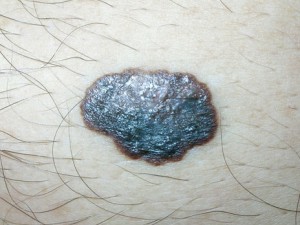Черное пятно с волнистыми краями, блестит, не болит, растет. Это меланома.