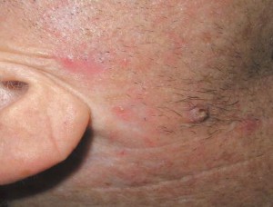 Опухоль на щеке в виде шершавой шишки с корочками на поврхности. Это плоскоклеточный рак кожи.