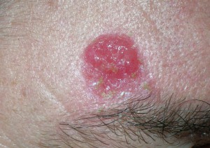 Рак кожи небольших размеров в виде красной блестяще бляшки с уплотнением. Начальная стадия.