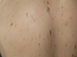 Наросты на коже в виде шершавых коричневых родинок. Фото себорейного кератоза.