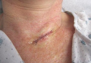 Рана зашита после хирургического удаления рака кожи. Слегка красновата и отечна.