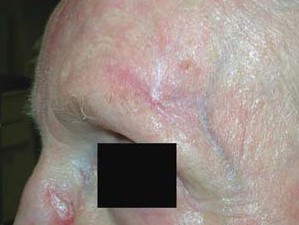 Небольшой рубец в виде белой звезды после лечения рака кожи местной химиотерапией.