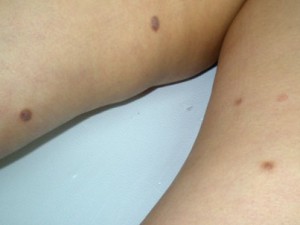 Красные или темные шишки на ногах, не болят, плотные. На фото дерматофибромы.