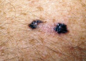 Меланома кожи в виде пятна в центре светлая, по бокам черная.
