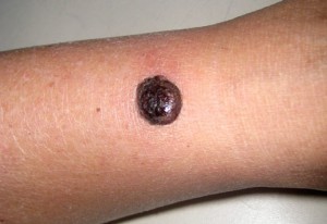 Меланома кожи в виде узла на руке. Окраска от темно - коричневой до черной.