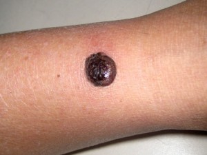Меланома кожи в виде узла на руке. Окраска от темно - коричневой до черной.