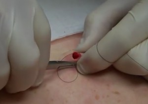 После хирургического удаления невуса рану кожи зашивают нитками.