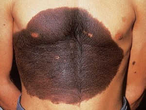 Врожденный пигментный невус на фото имеет волосы, опасен меланомой.