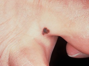 Пограничный пигментный невус кожи руки в виде плоского черного пятна.