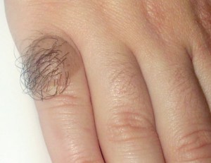 Врожденный пигментный невус в виде коричневого пятна, покрытого волосами.