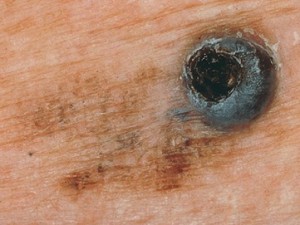 На фоне плоской черной родинки участок с шишечкой - это меланома.