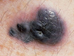 На фото меланома из голубого невуса.