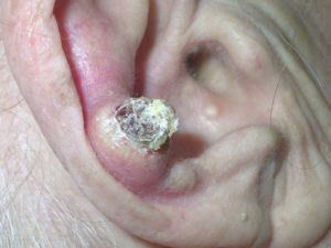 На фото на коже уха нарост с колпачком - кератоакантома.