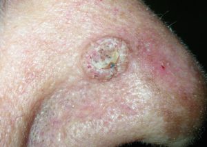 Плоскоклеточный рак на коже в виде нароста.