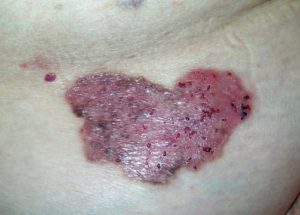 Симптомы базльноклеточного рака кожи на фото.