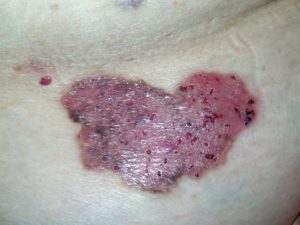 Симптомы базальноклеточного рака кожи на фото.
