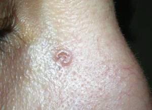 Симптомы рака кожи типа узловой базалиомы на фото.