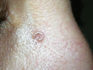 Симптомы рака кожи типа узловой базалиомы на фото.