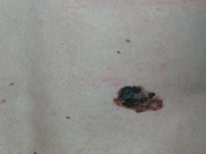 Меланома кожи на фото - симптомы рака кожи.